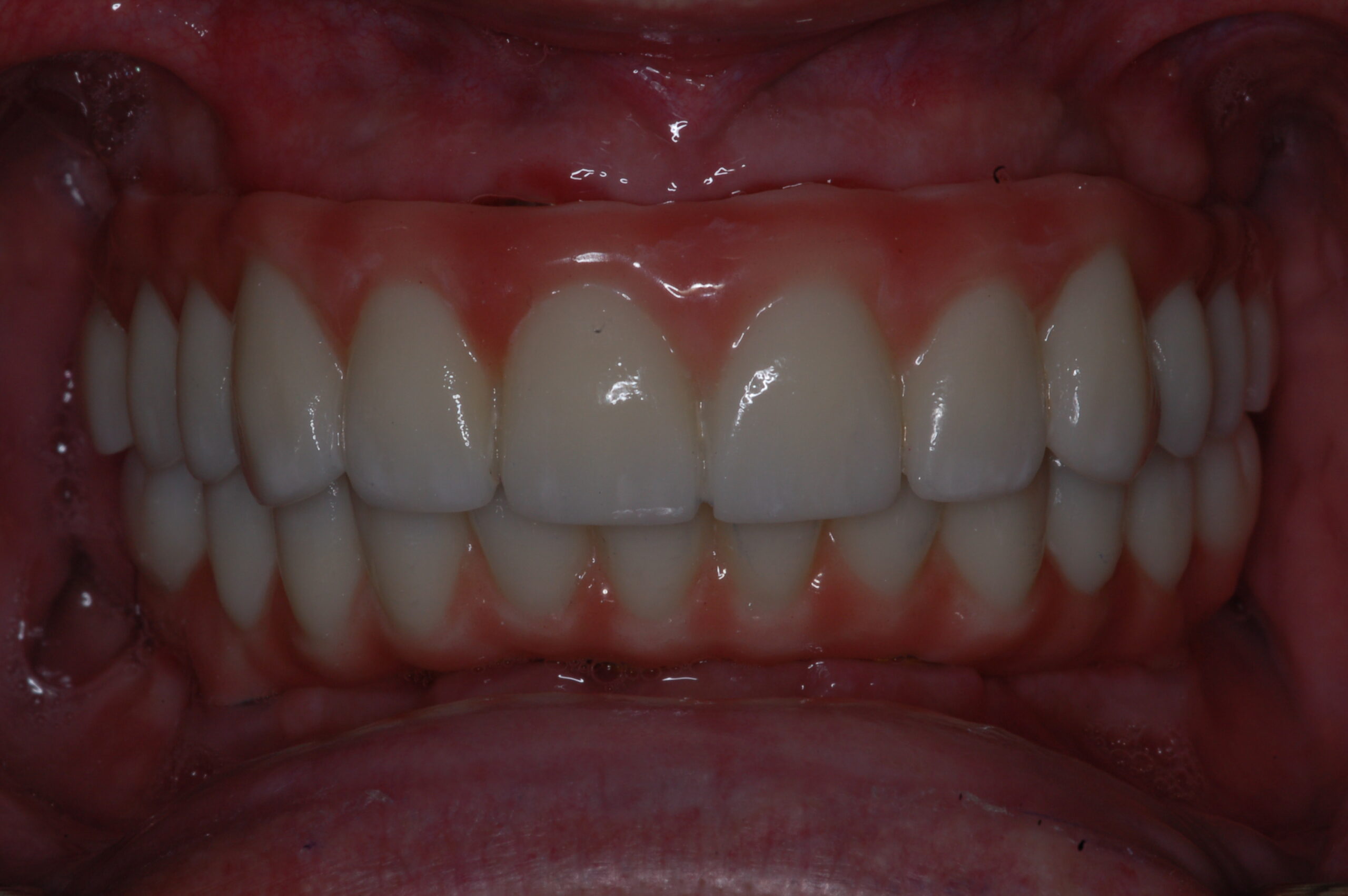 Renewed Smile with Dental Implants