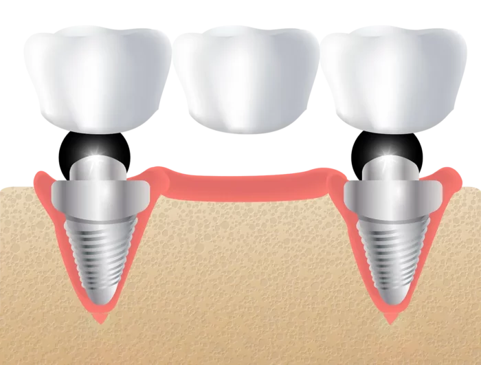 Multiple tooth dental implant