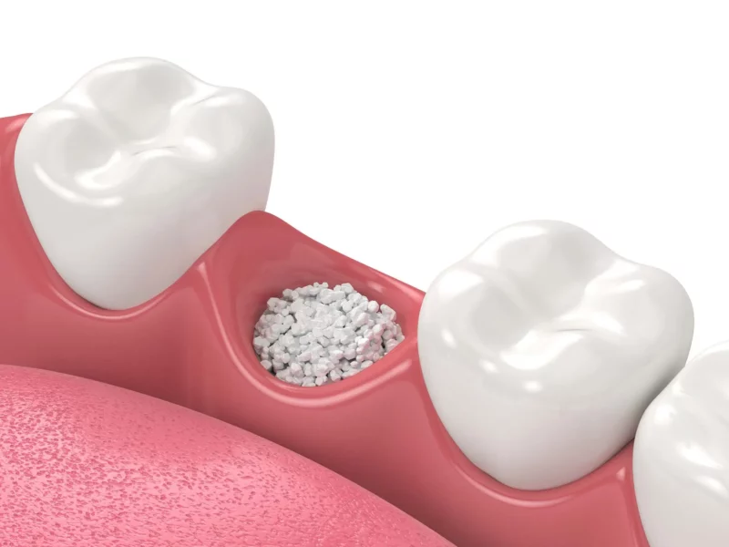 SEDA Dental are bone grafting experts