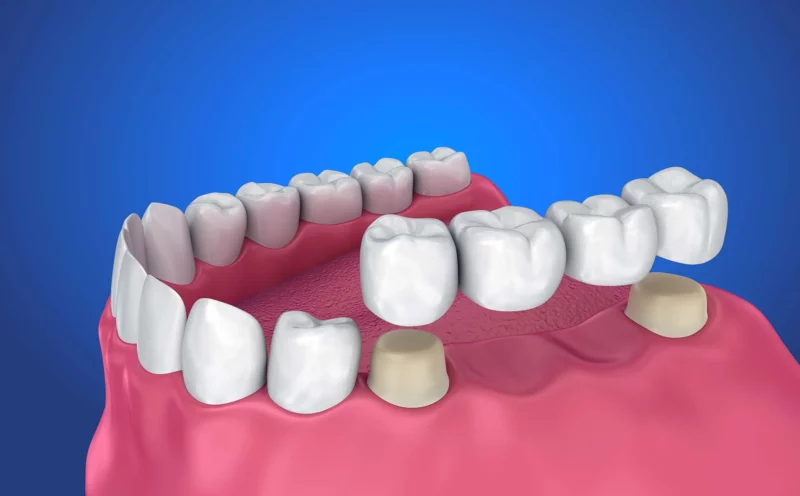 Dental Bridge at SEDA Dental