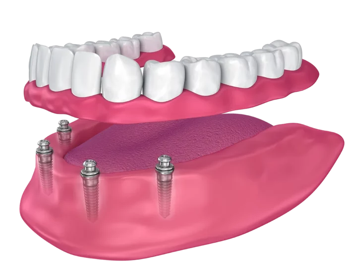 All-on-4 dental implant