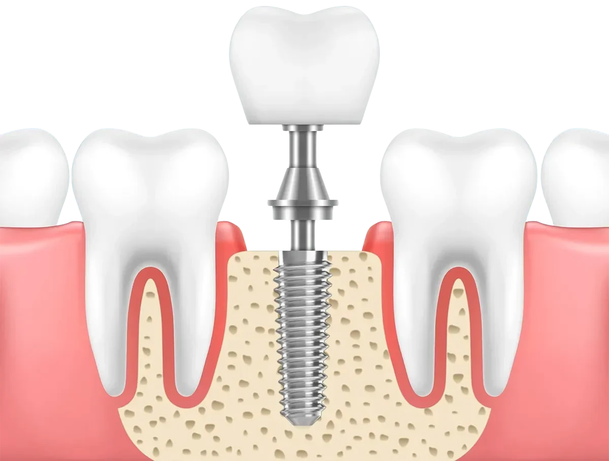single tooth dental implants