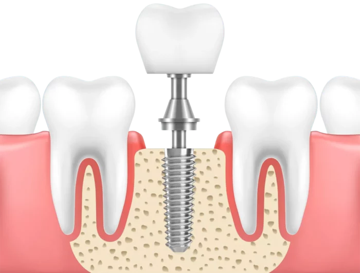 SEDA Dental performs single tooth dental implant surgery