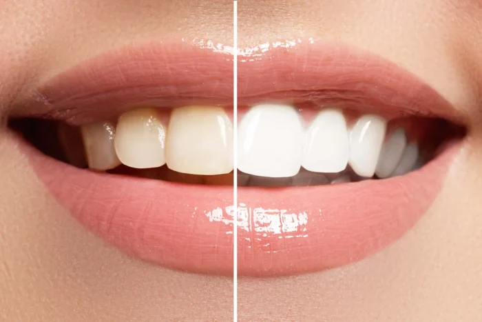 Teeth Whitening at SEDA Dental